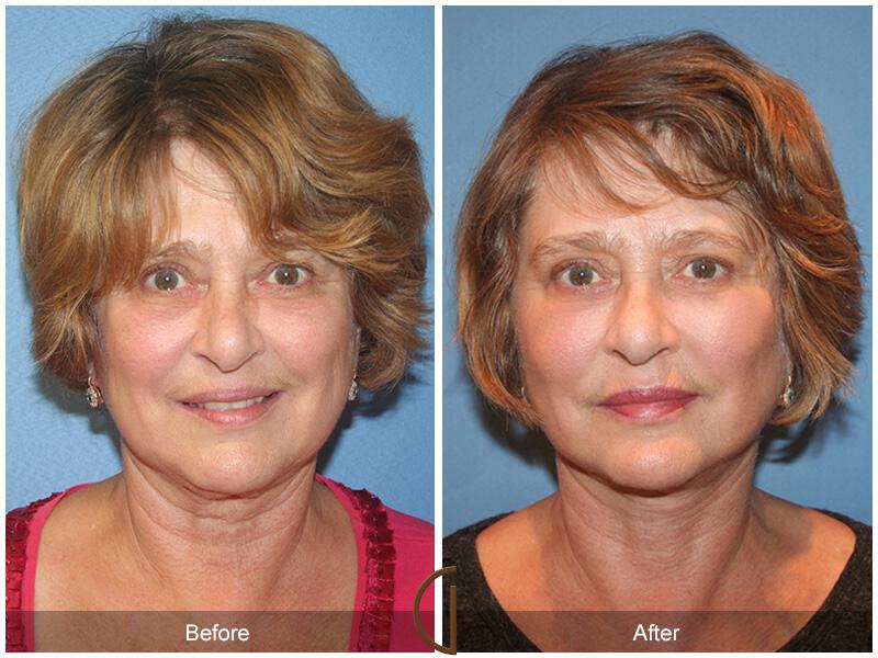 Facelift Sixties Before & After Photo