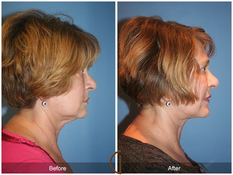 Facelift Sixties Before & After Photo