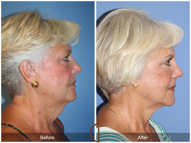 Facelift Sixties Before & After Photo