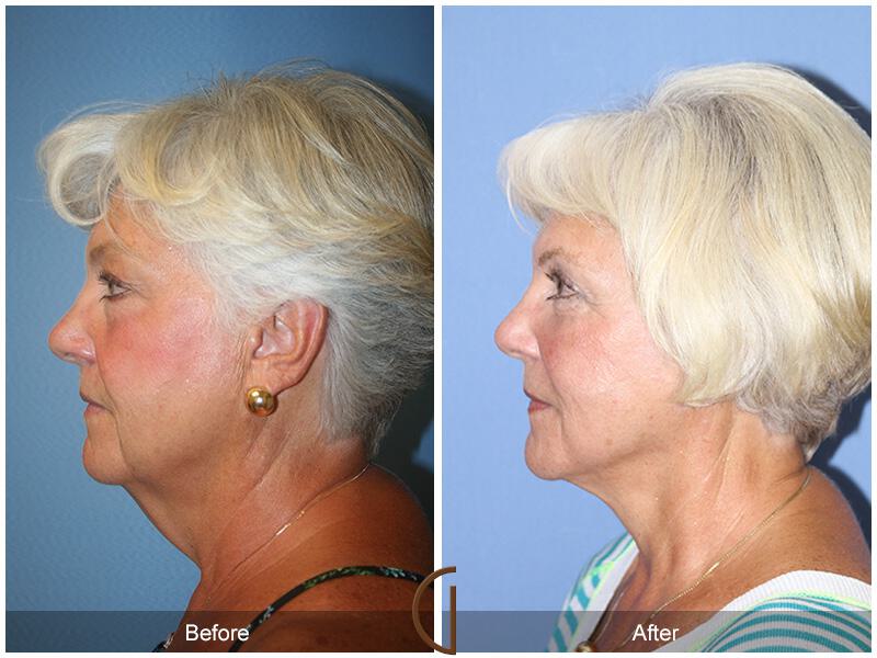 Facelift Sixties Before & After Photo