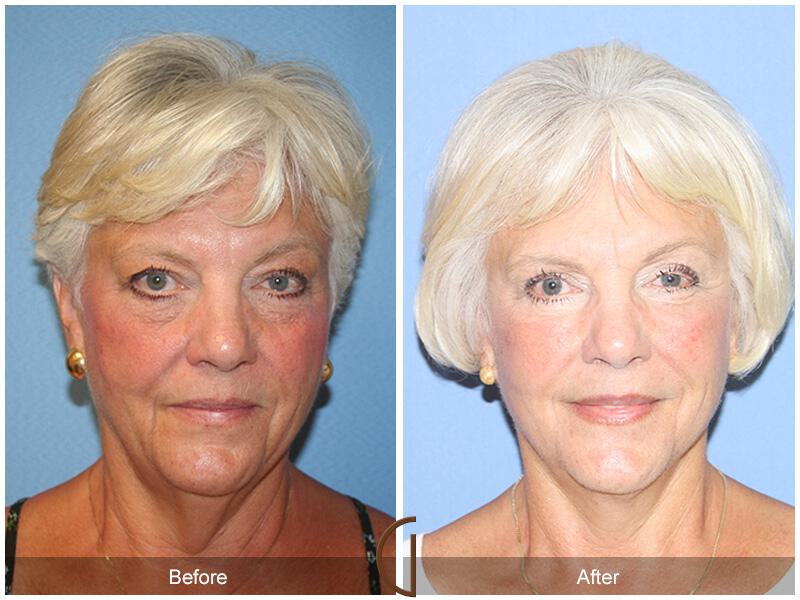 Facelift Sixties Before & After Photo