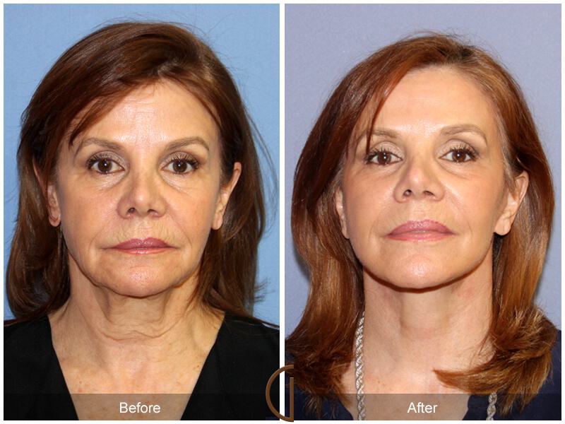 Facelift Sixties Before & After Photo