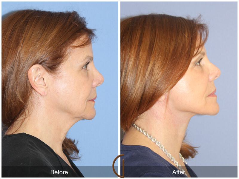 Facelift Sixties Before & After Photo