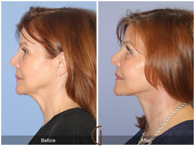 Facelift Sixties Before & After Photo