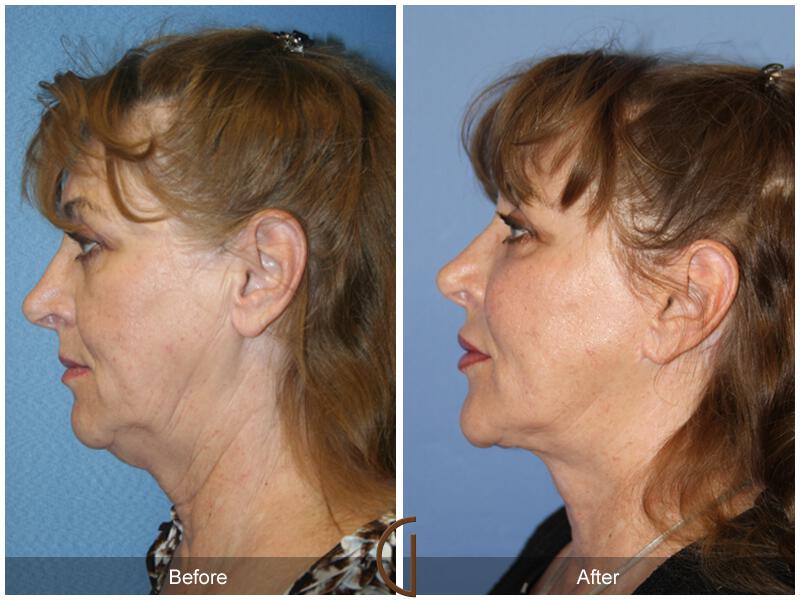 Facelift Sixties Before & After Photo