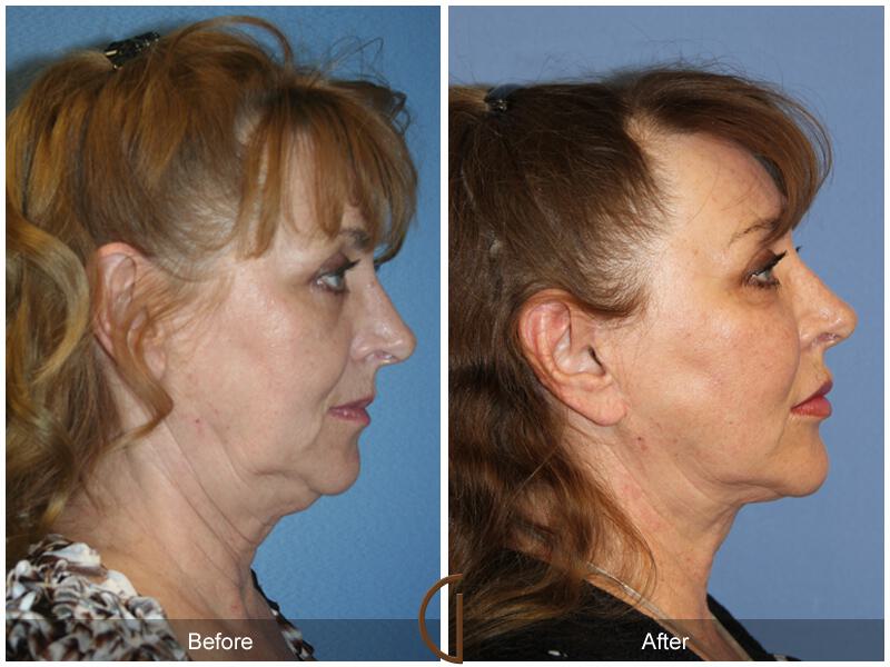 Facelift Sixties Before & After Photo