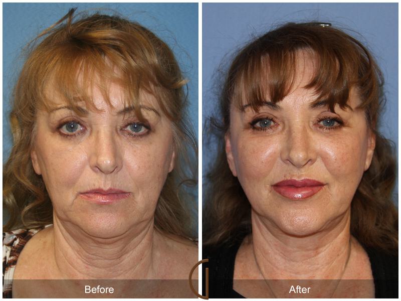 Facelift Sixties Before & After Photo