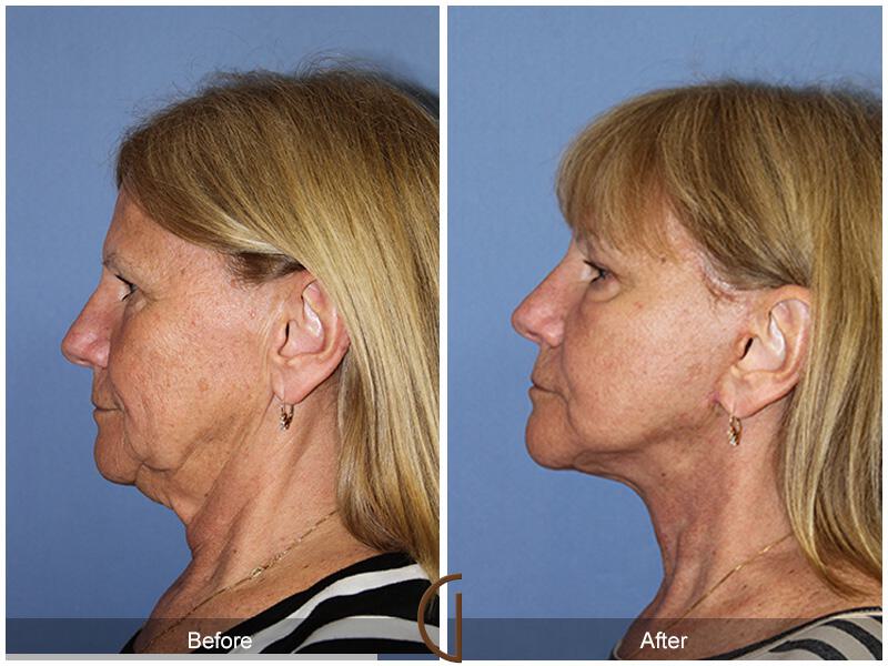 Facelift Sixties Before & After Photo