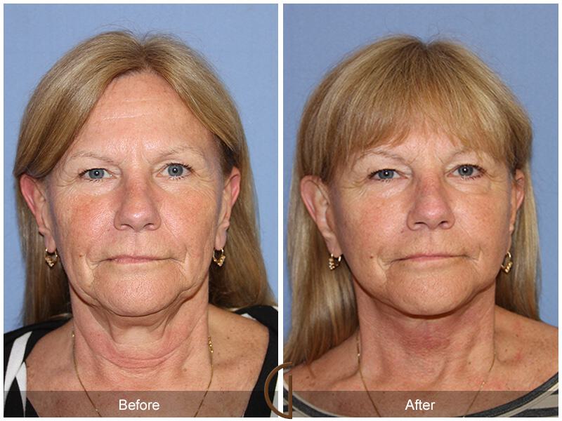 Facelift Sixties Before & After Photo