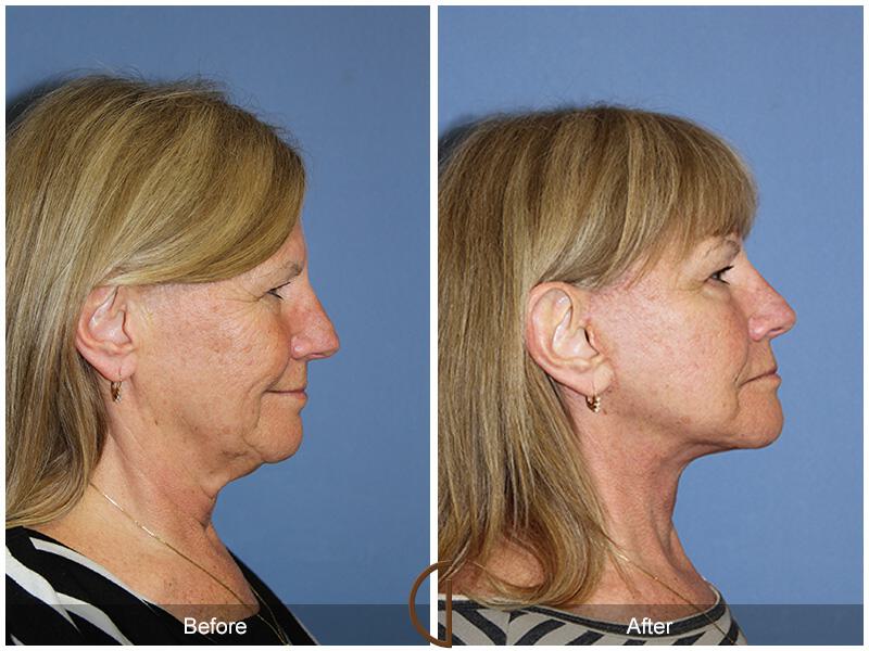 Facelift Sixties Before & After Photo