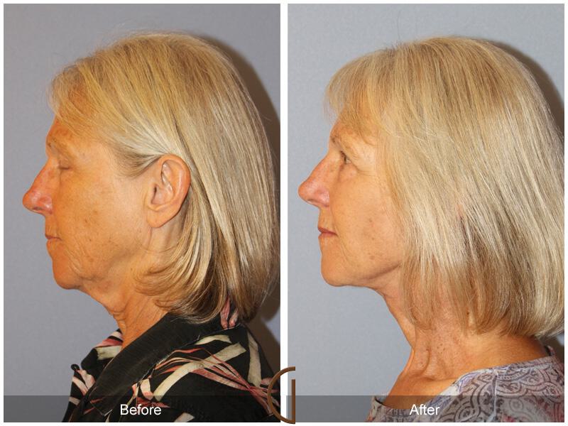 Facelift Sixties Before & After Photo