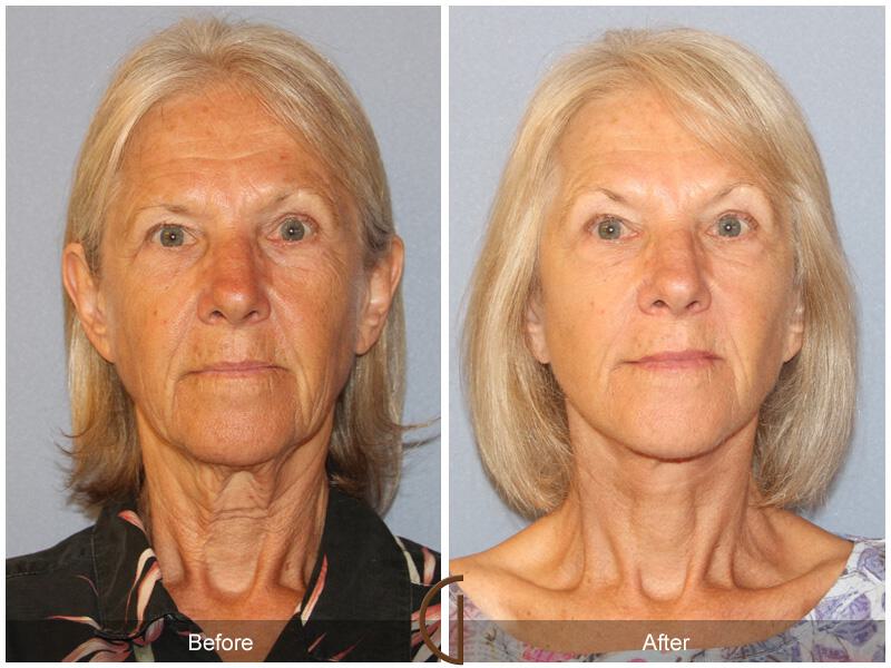 Facelift Sixties Before & After Photo