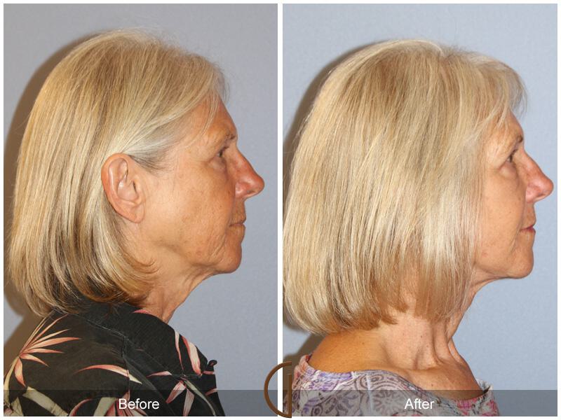 Facelift Sixties Before & After Photo