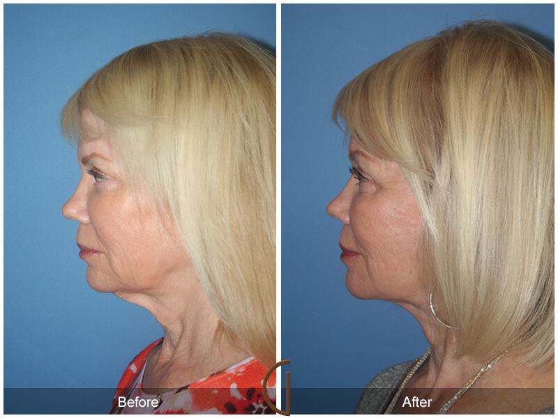 Facelift Sixties Before & After Photo