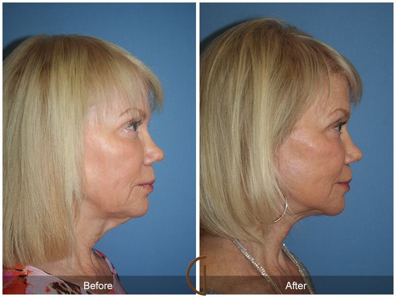 Facelift Sixties Before & After Photo