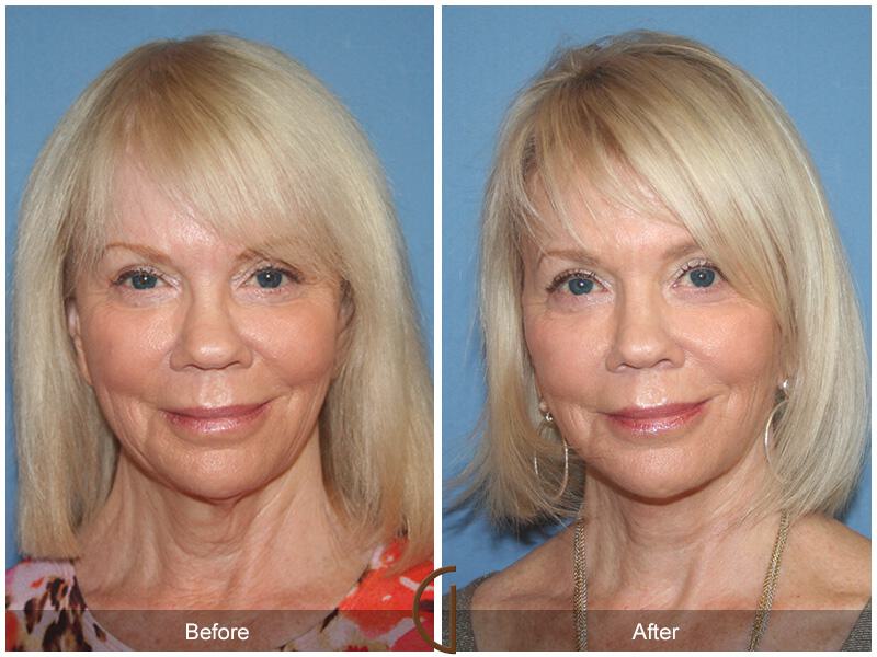 Facelift Sixties Before & After Photo