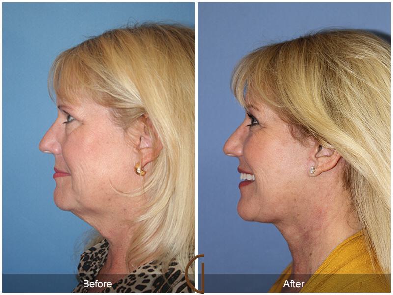 Facelift Sixties Before & After Photo