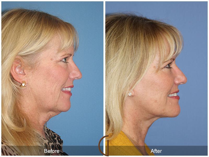 Facelift Sixties Before & After Photo