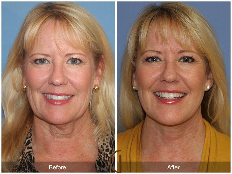 Facelift Sixties Before & After Photo