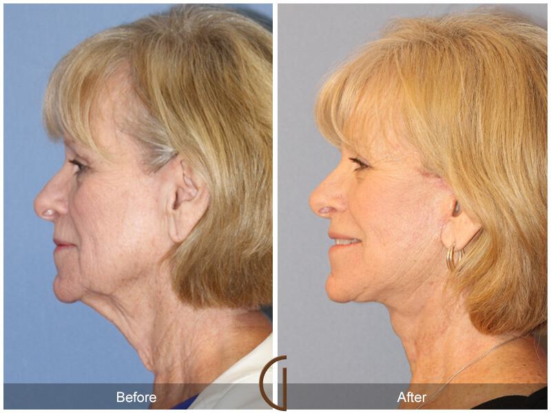 Facelift Sixties Before & After Photo