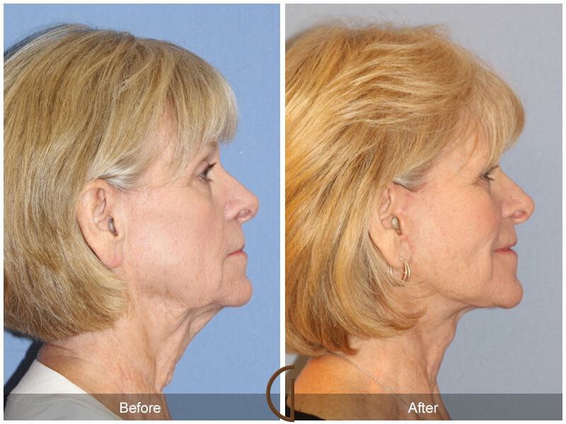 Facelift Sixties Before & After Photo