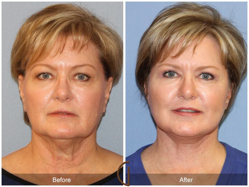 Facelift Sixties Before & After Photo