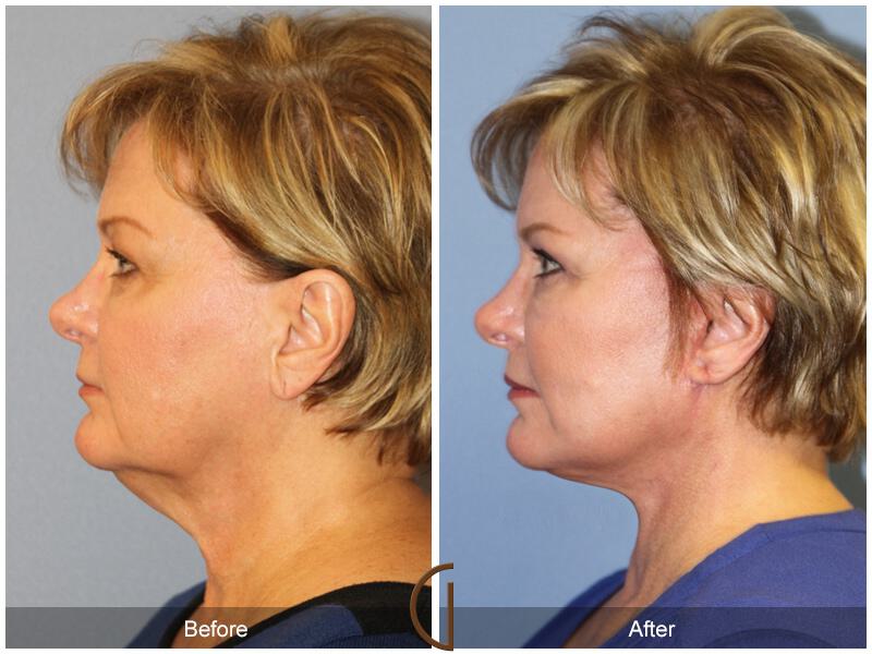 Facelift Sixties Before & After Photo