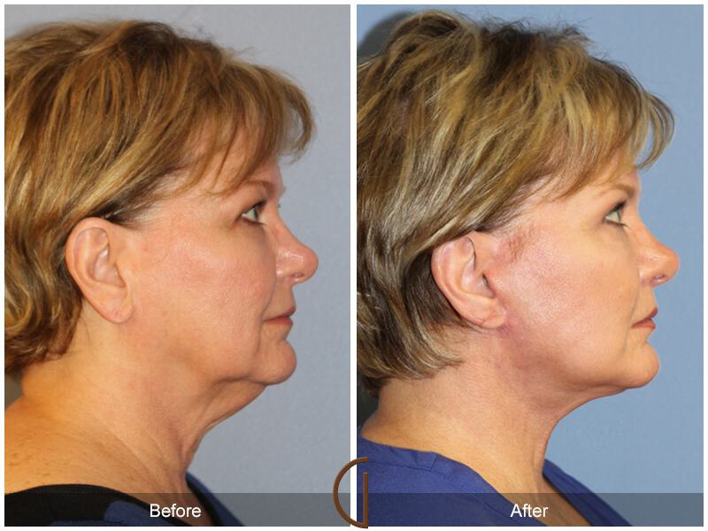 Facelift Sixties Before & After Photo