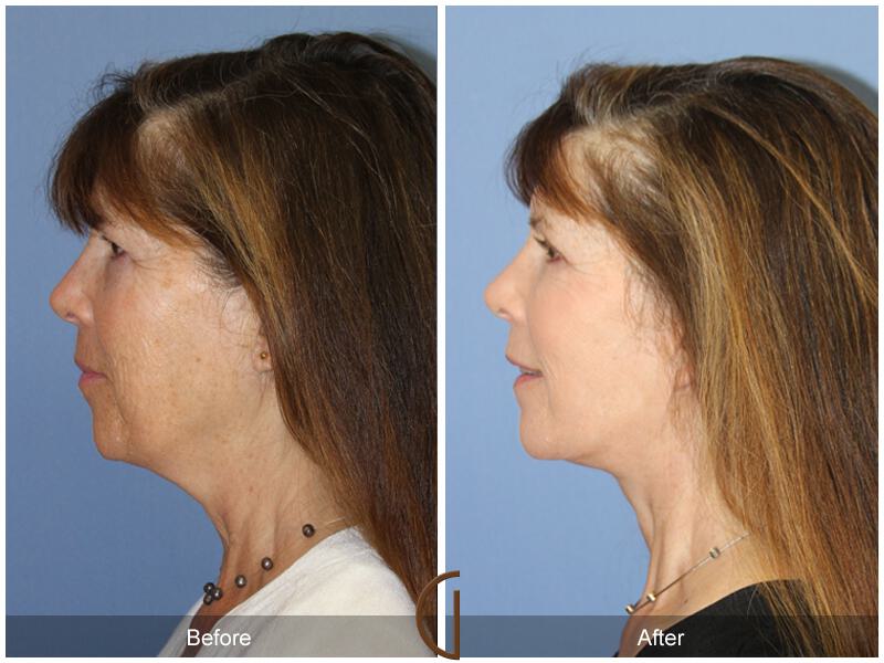 Facelift Sixties Before & After Photo