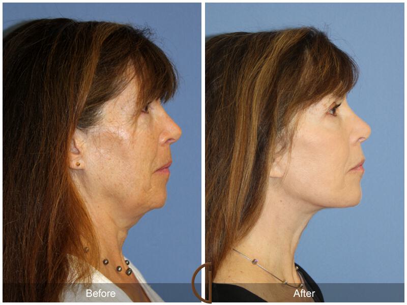 Facelift Sixties Before & After Photo