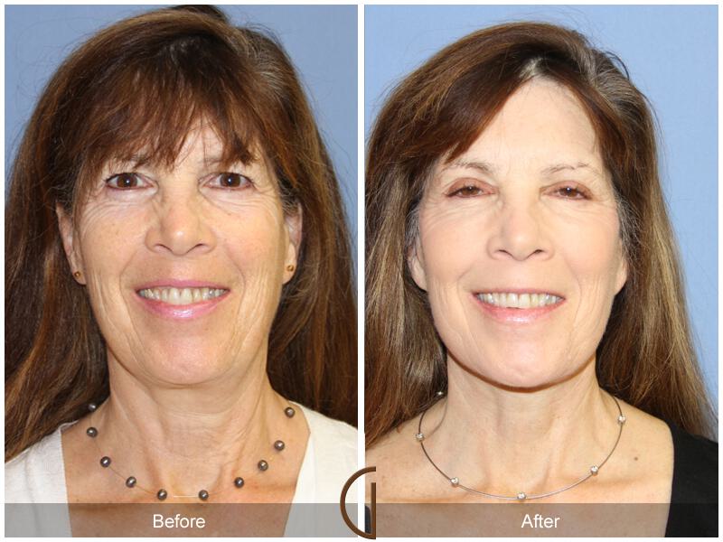 Facelift Sixties Before & After Photo