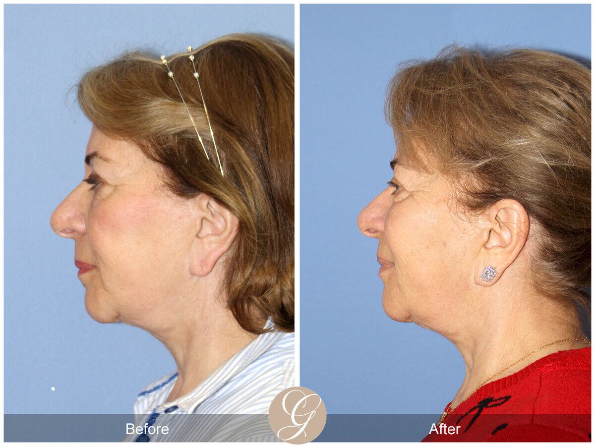 Facelift Sixties Before & After Photo