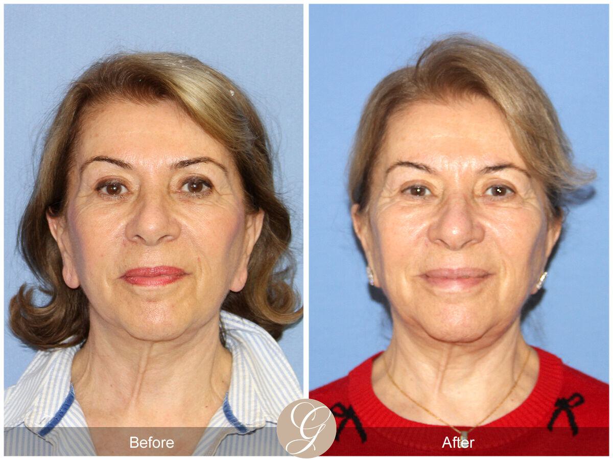 Facelift Sixties Before & After Photo