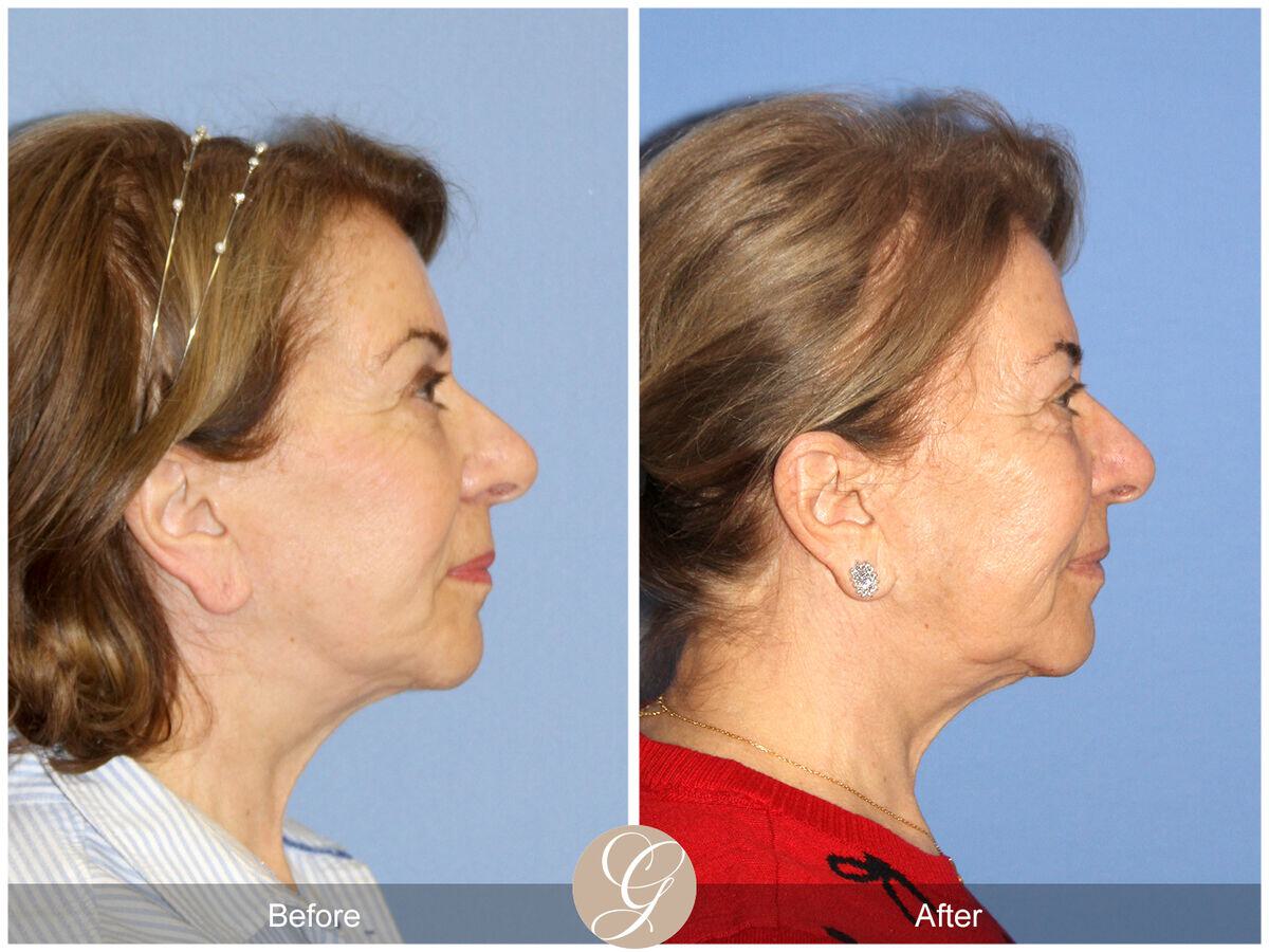 Facelift Sixties Before & After Photo