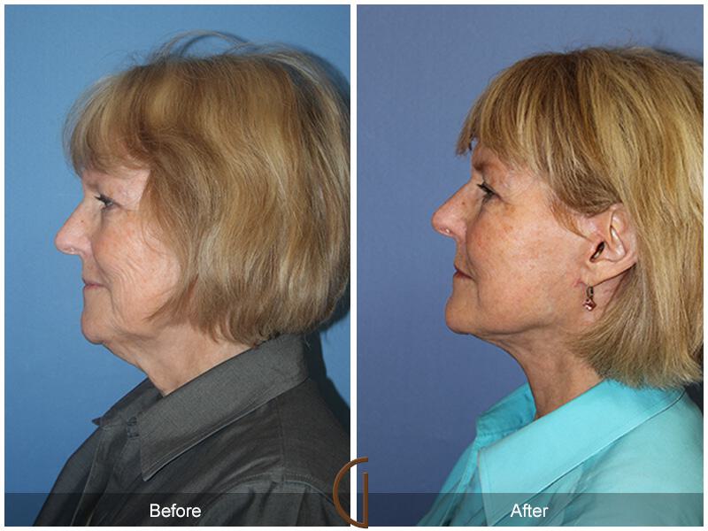 Facelift Sixties Before & After Photo