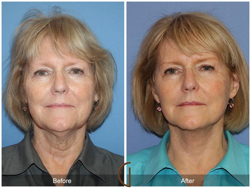 Facelift Sixties Before & After Photo