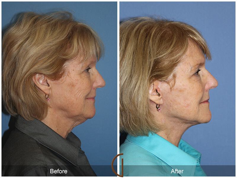 Facelift Sixties Before & After Photo