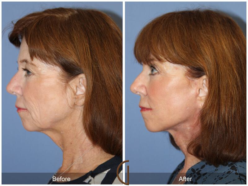 Facelift Sixties Before & After Photo