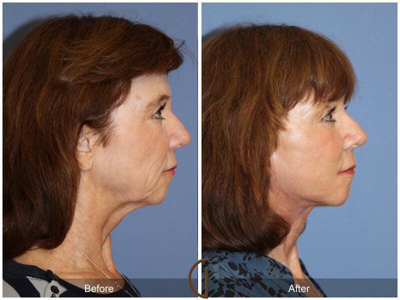 Facelift Sixties Before & After Photo