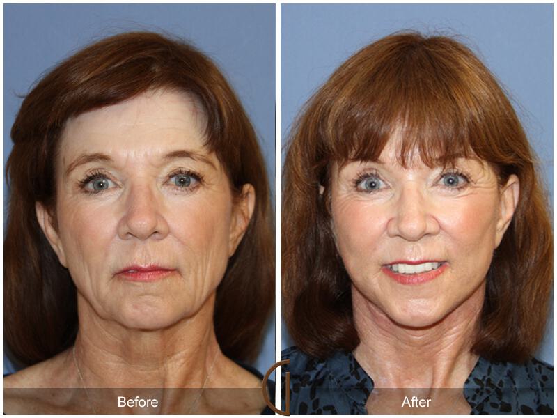 Facelift Sixties Before & After Photo