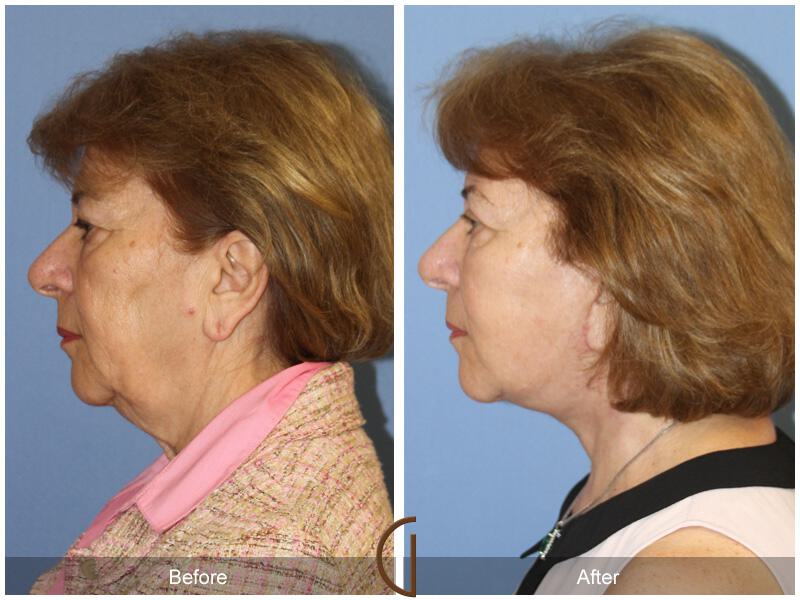 Facelift Sixties Before & After Photo