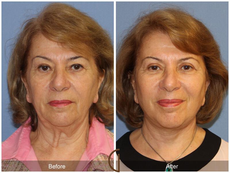 Facelift Sixties Before & After Photo