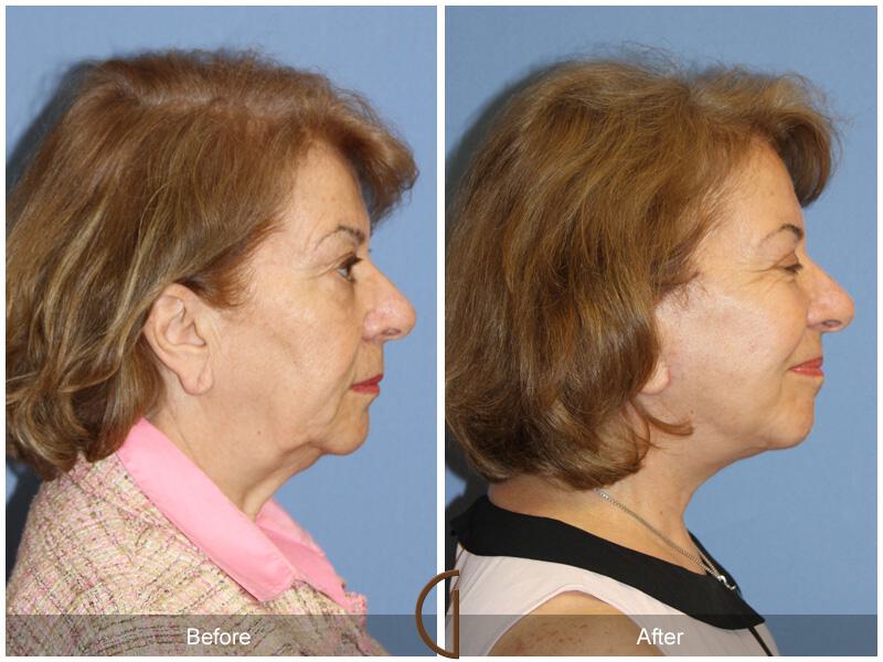 Facelift Sixties Before & After Photo