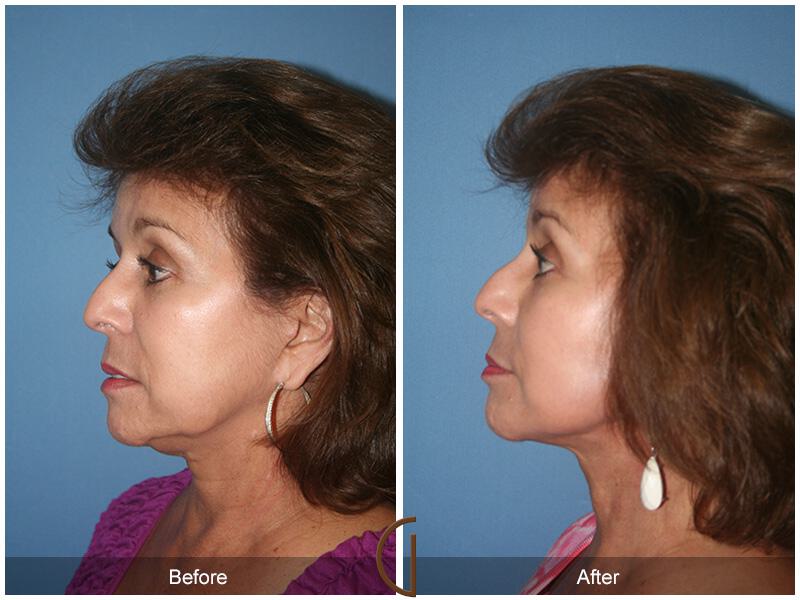 Facelift Sixties Before & After Photo