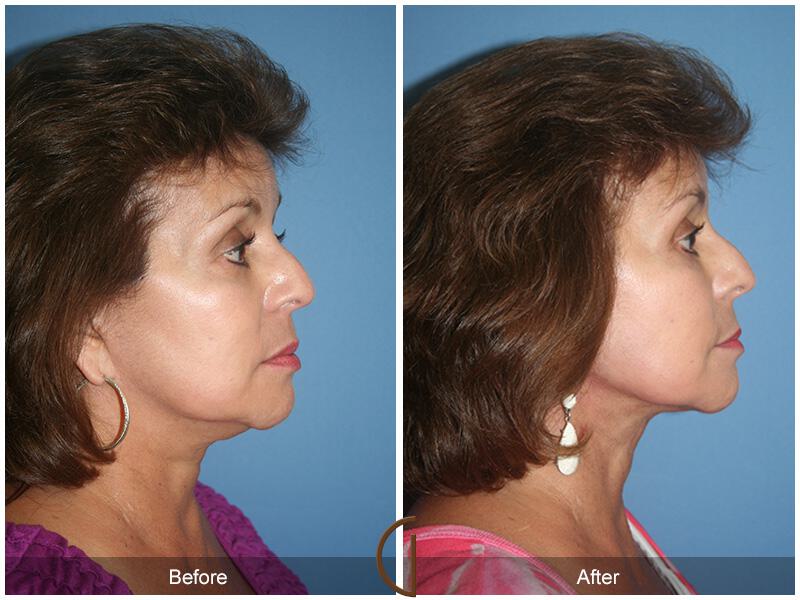 Facelift Sixties Before & After Photo