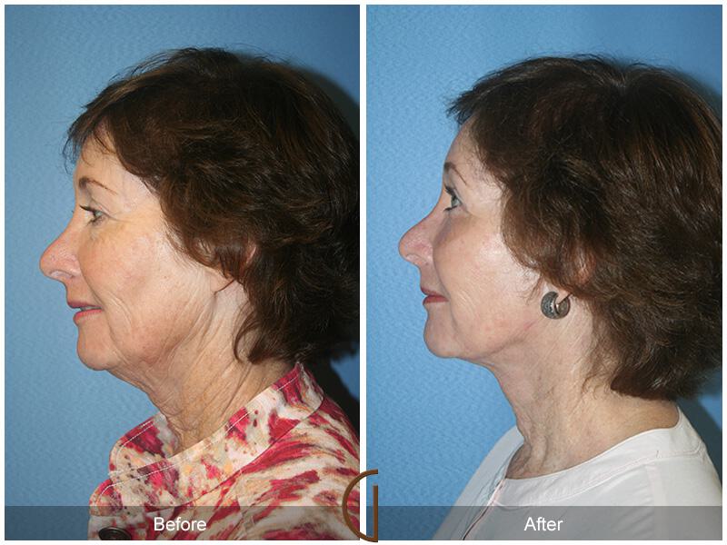 Facelift Sixties Before & After Photo