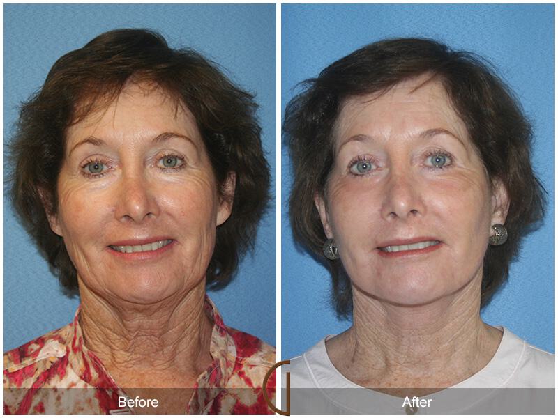 Facelift Sixties Before & After Photo