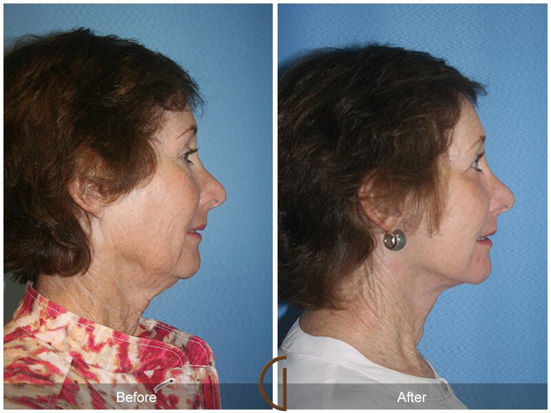 Facelift Sixties Before & After Photo