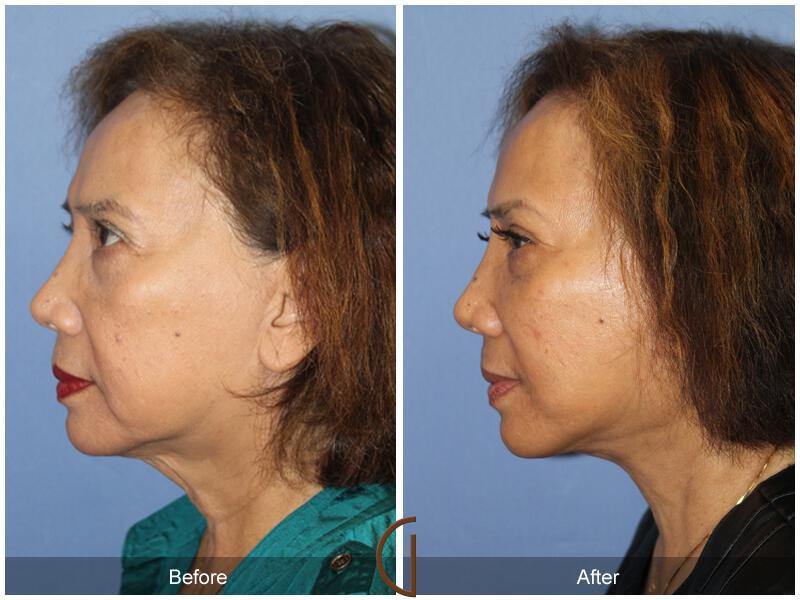 Facelift Sixties Before & After Photo