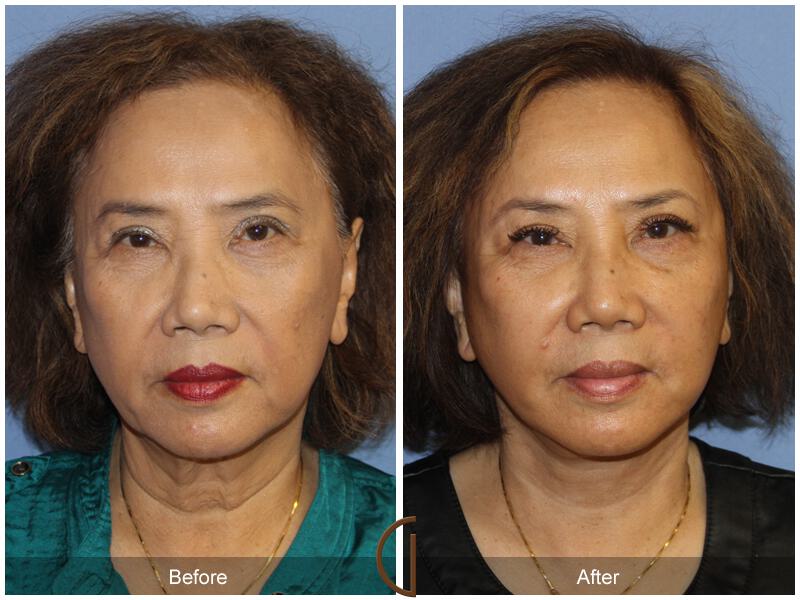 Facelift Sixties Before & After Photo